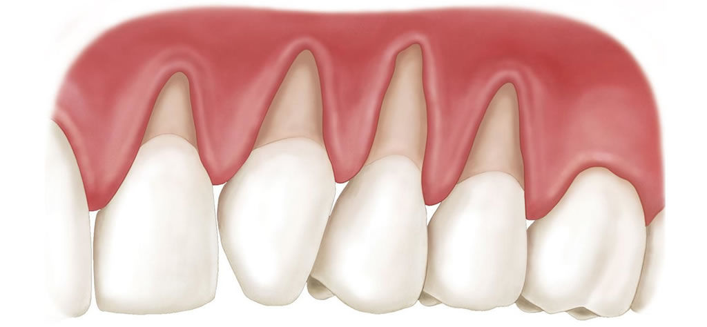 Gum Graft –Vancouver