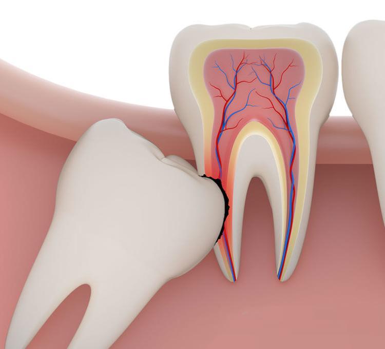 impacted wisdom tooth vancouver bc
