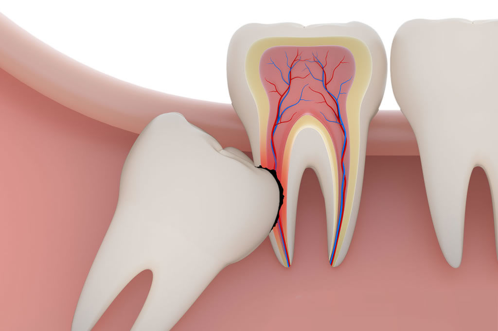 impacted wisdom tooth vancouver bc