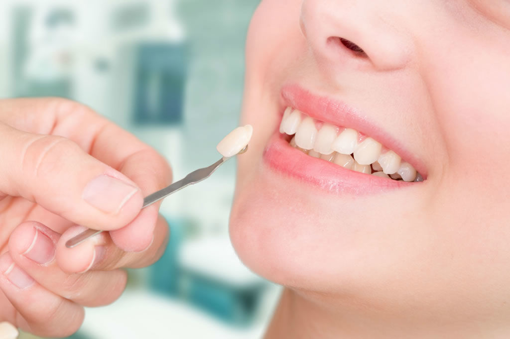 Dental crown Vancouver BC