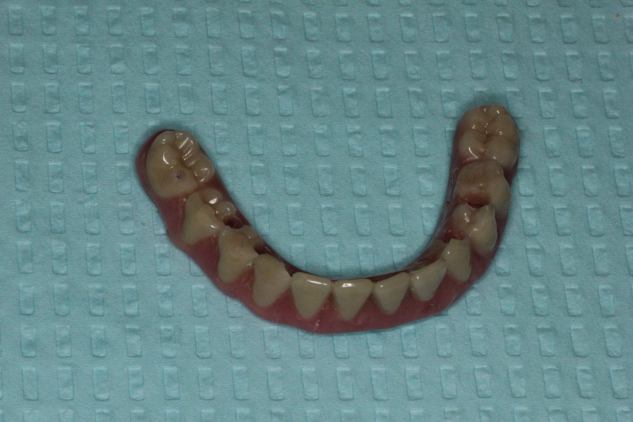 Implant Supported Overdenture_2