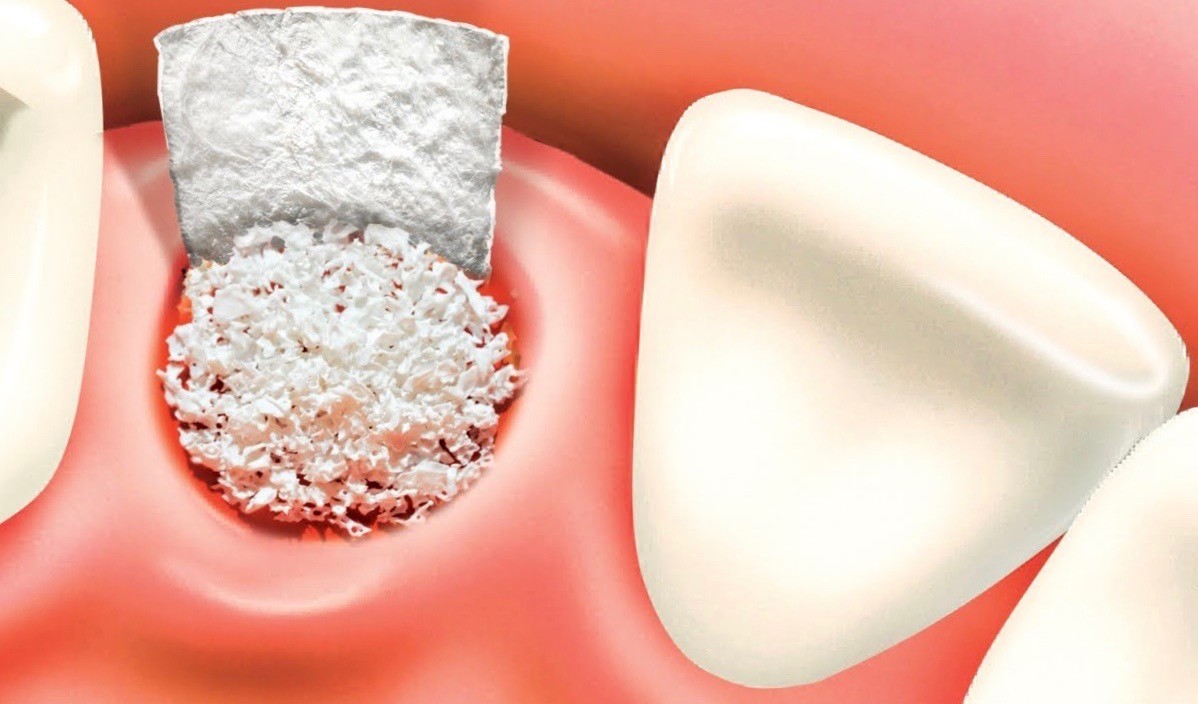 bone grafting for implants vancouver bc