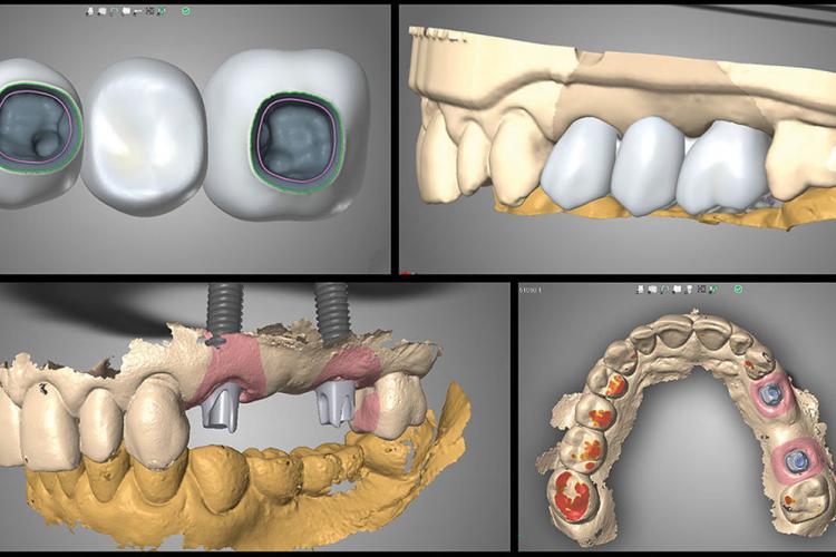 dental implants vancouver