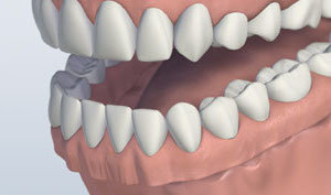 tooth-replacement-options-denture