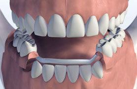 tooth-replacement-options-metal-partial
