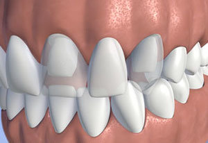 tooth-replacement-options