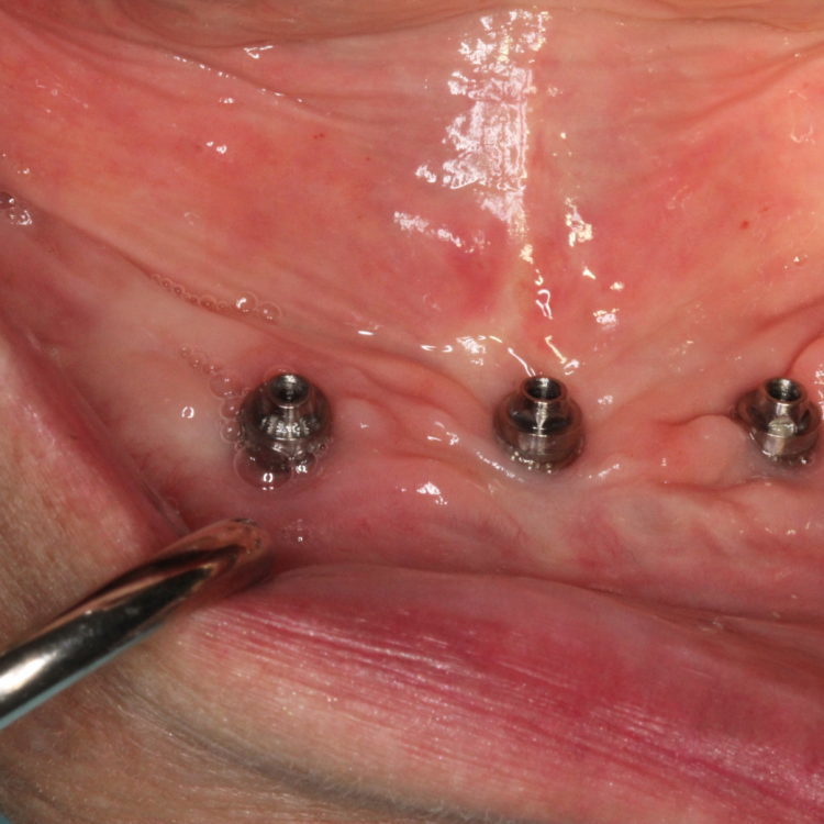 implants on edentoulous lower jaw