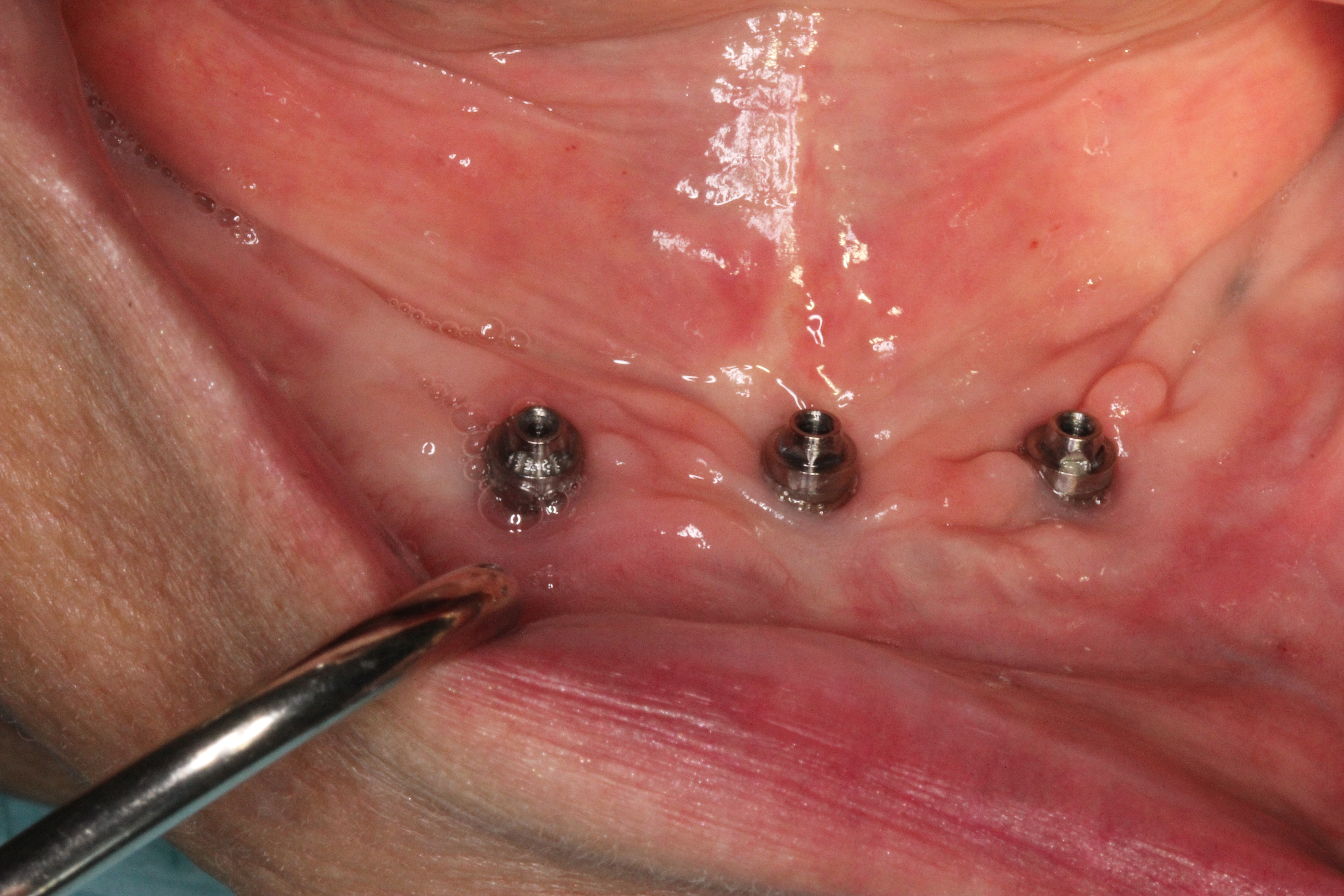 implants on edentoulous lower jaw