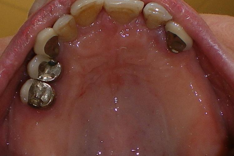 dental implant surgery vancouver bc