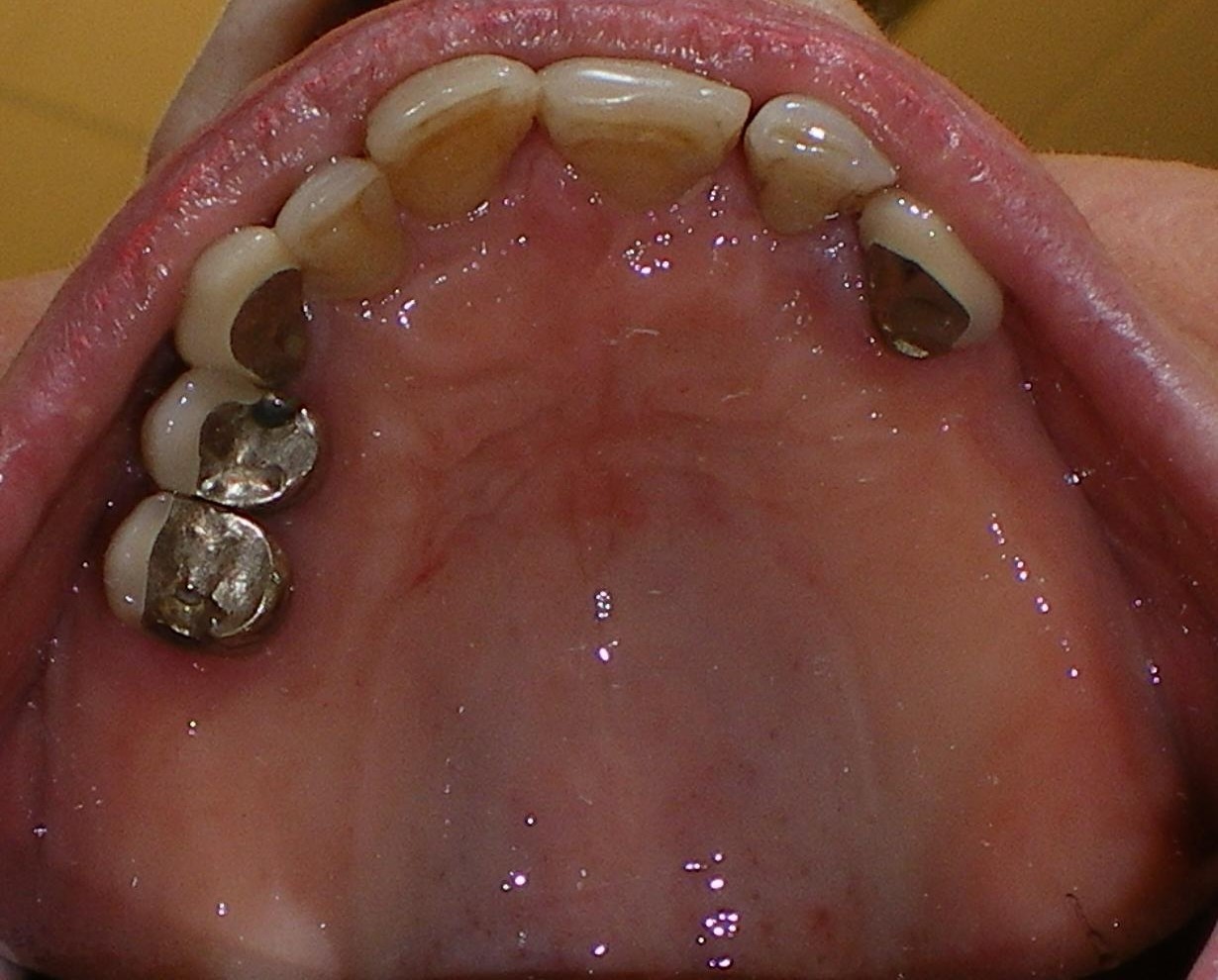 dental implant surgery vancouver bc