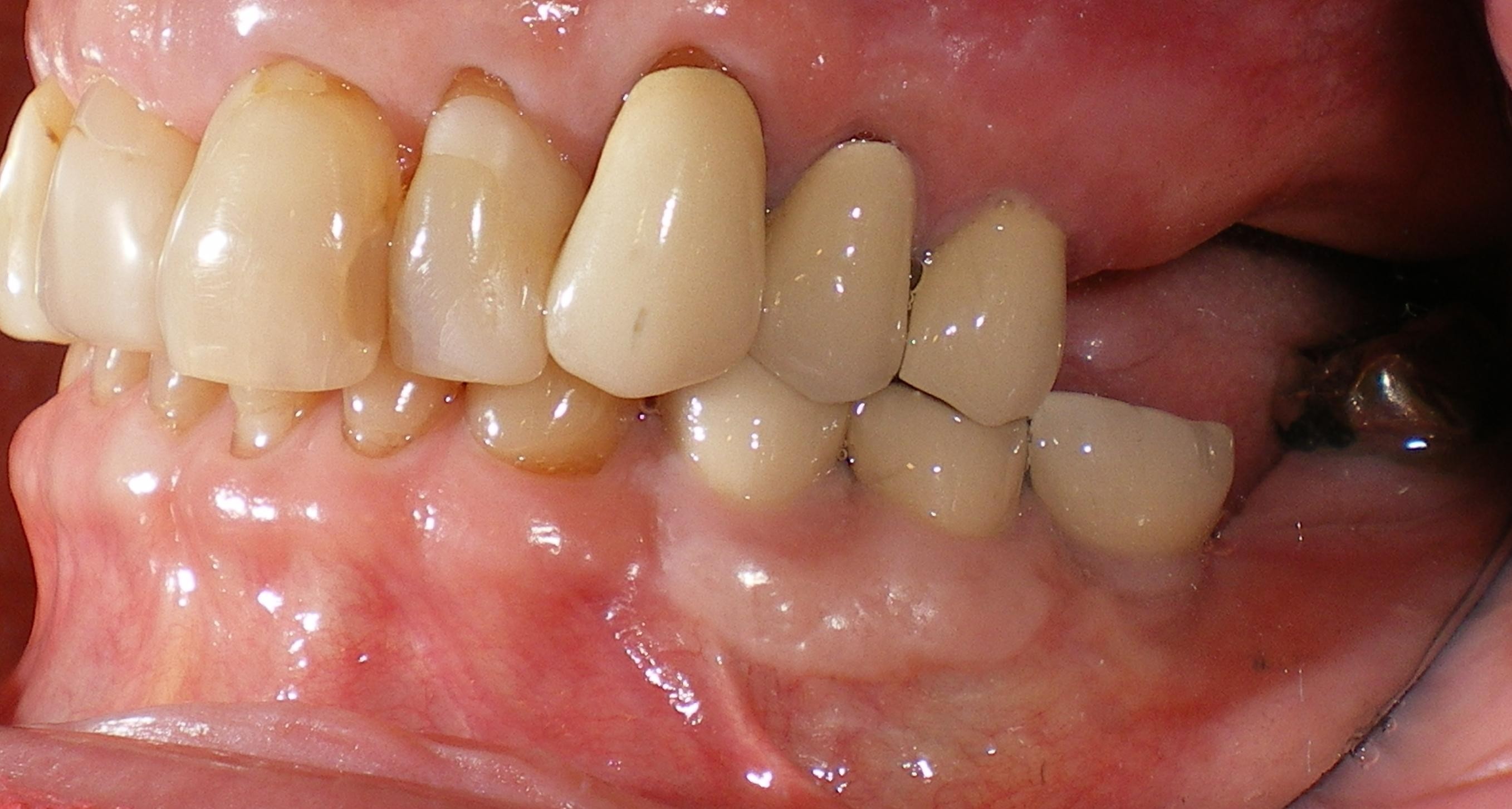 dental implant surgery vancouver bc
