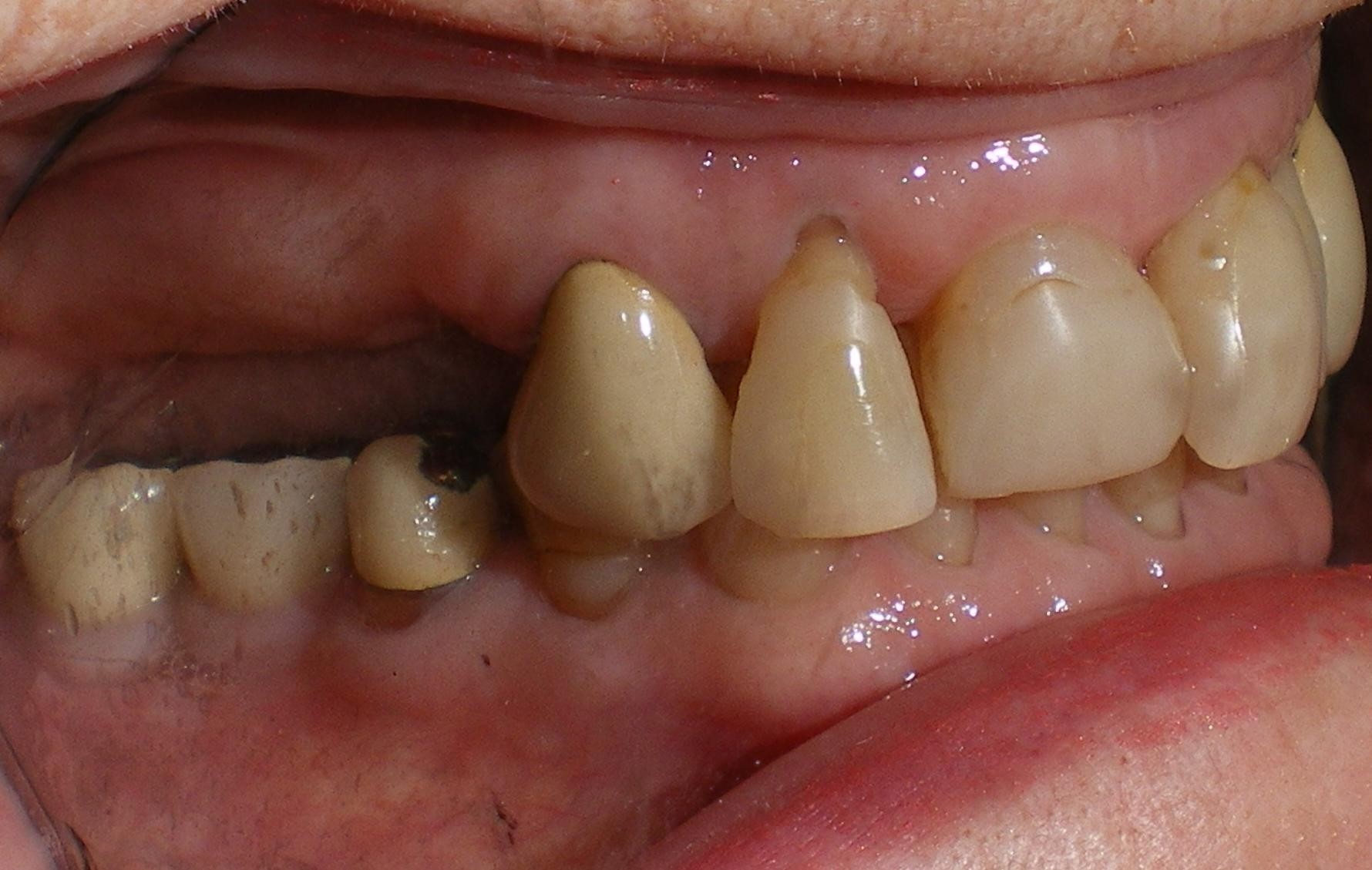 implant retained dentures vancouver bc