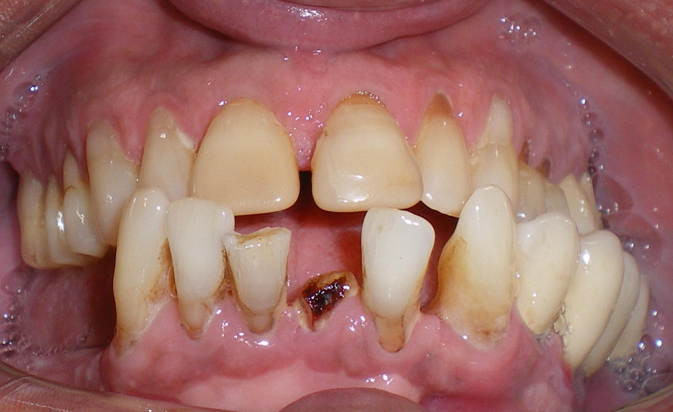 Replace Missing Teeth Vancouver BC