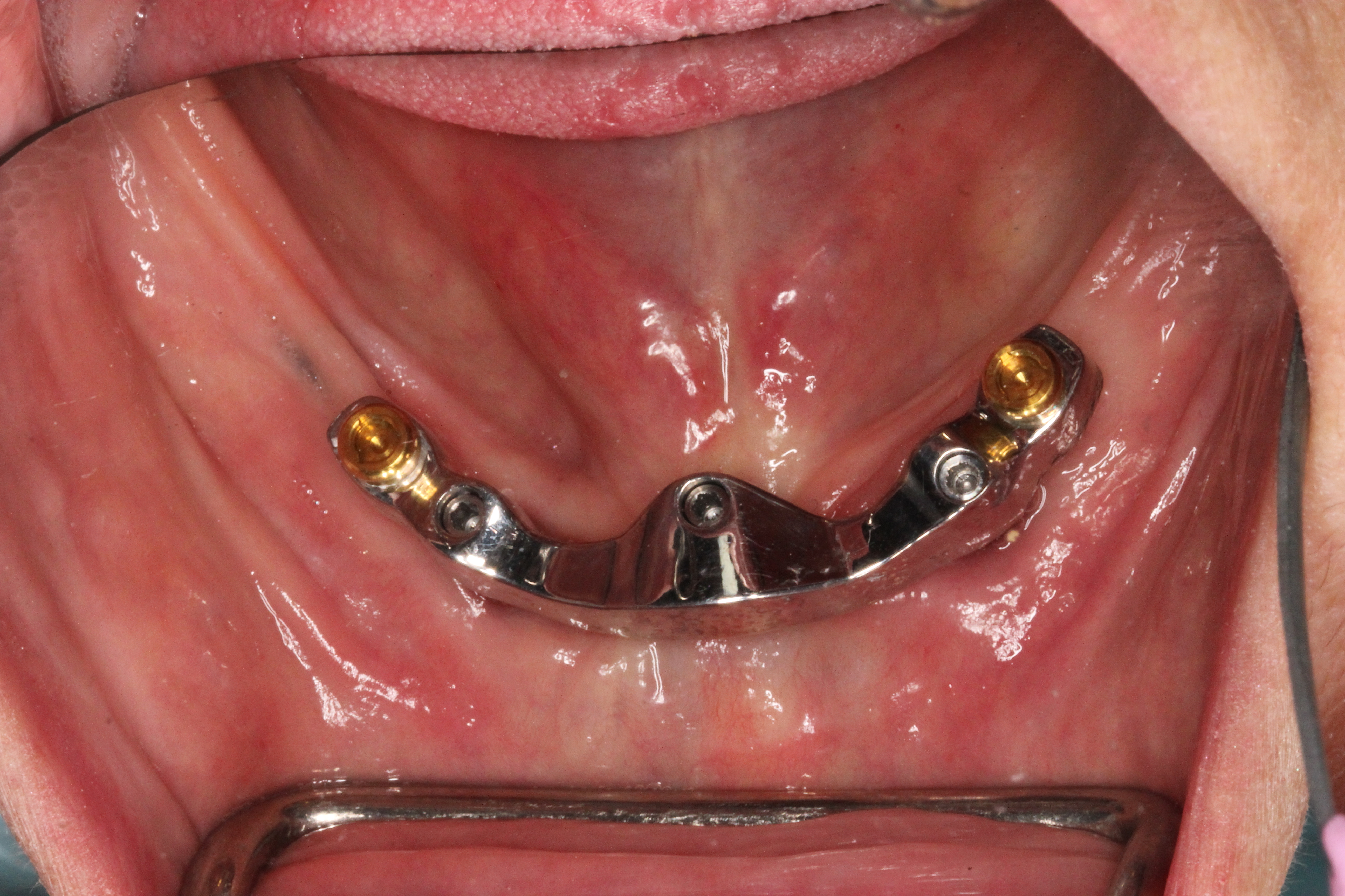 Titanium Bar Over Implant Lower Jaw Vancouver BC