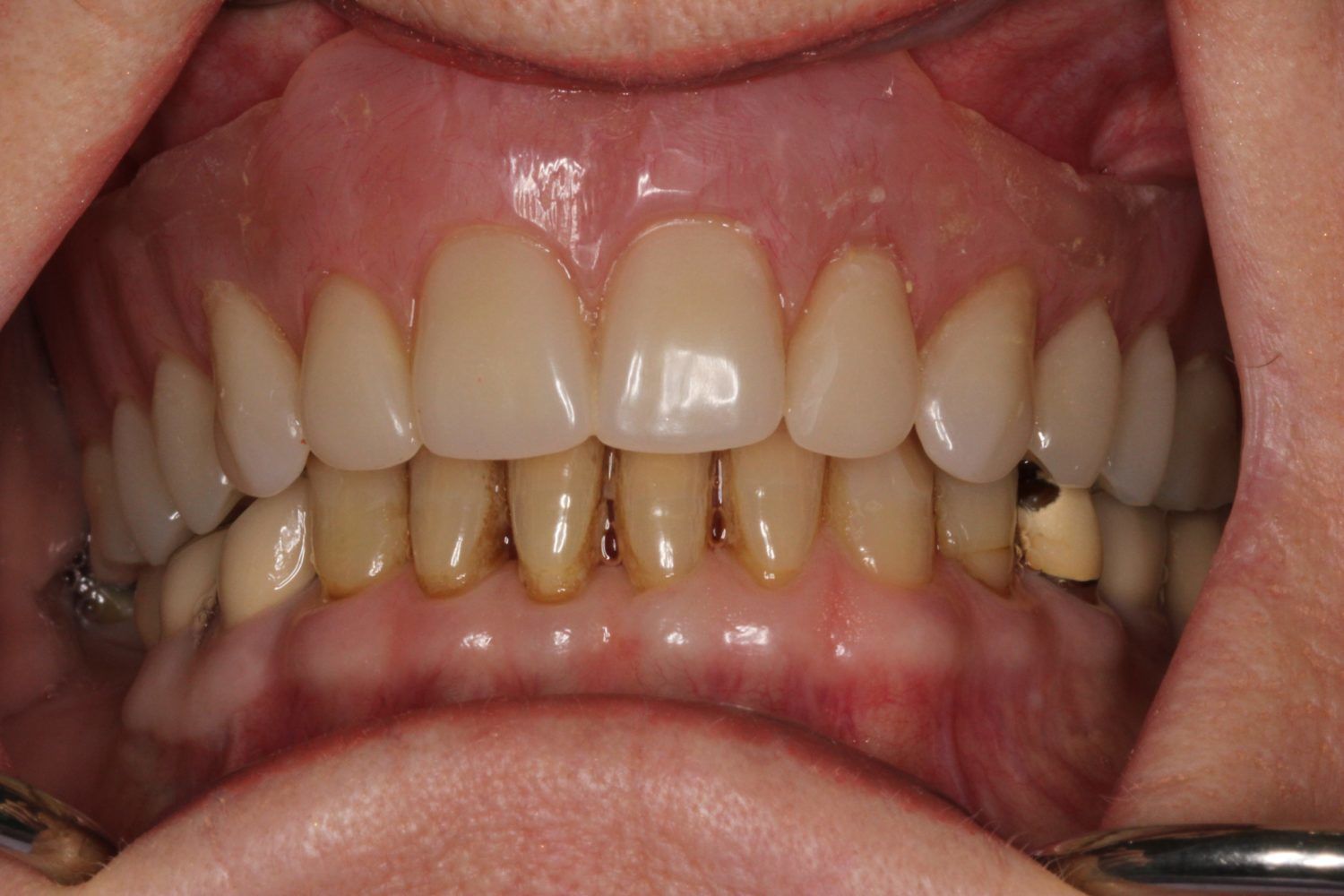 implant retained dentures vancouver bc