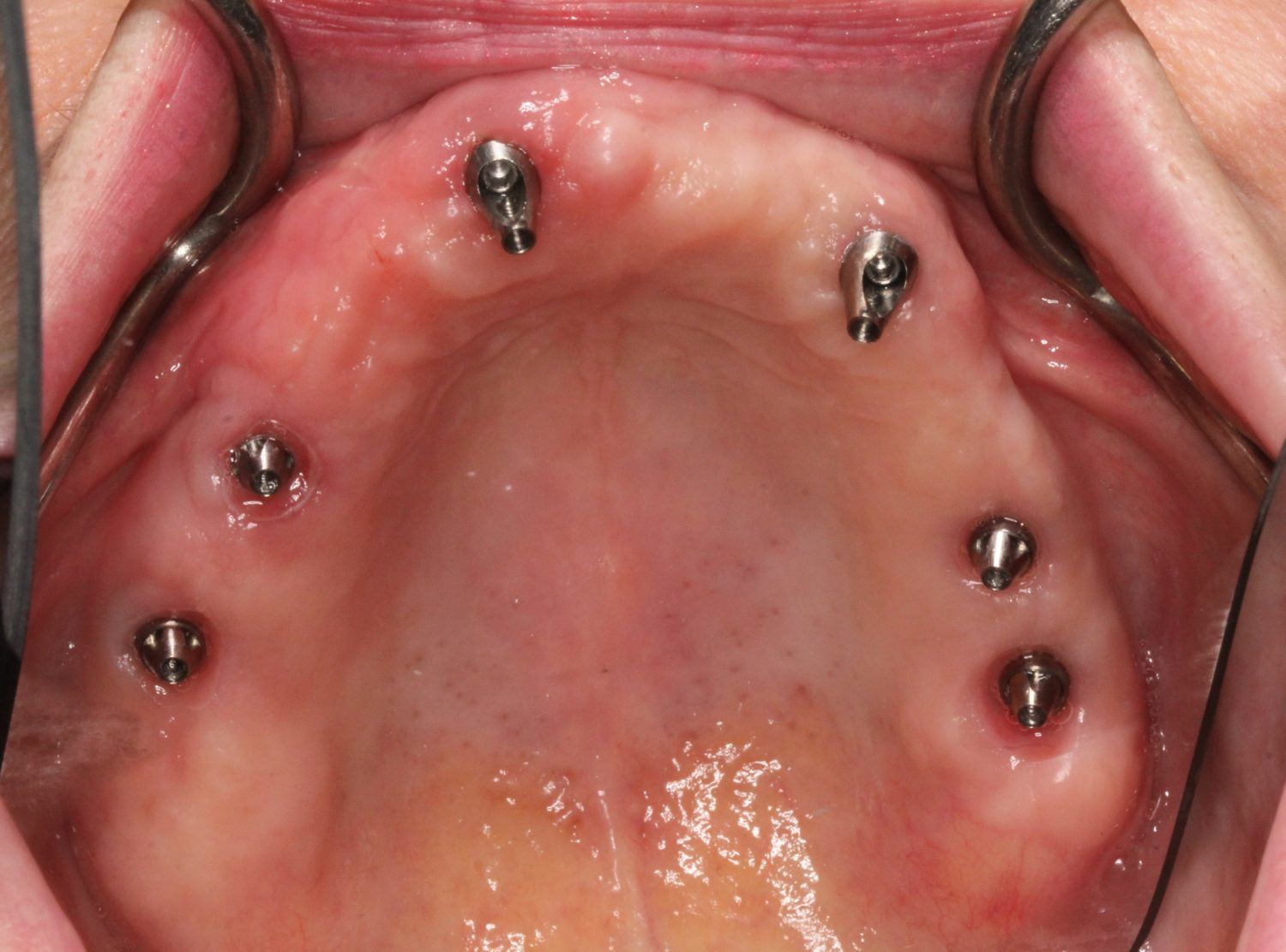implant retained dentures vancouver bc