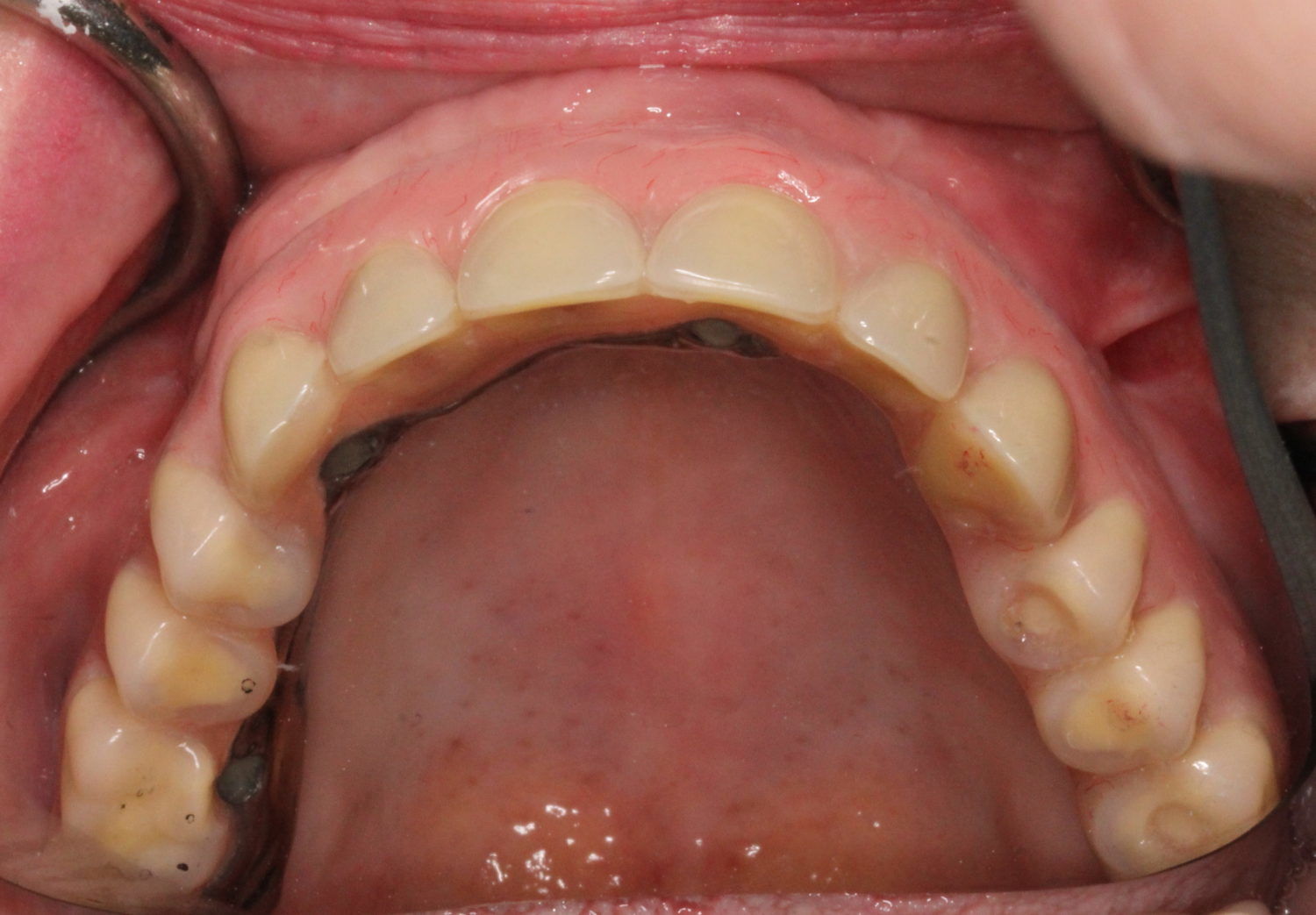 implant fixed supported prosthesis vancouver bc