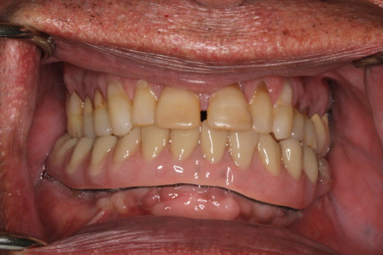 intra oral view of the fixed implant supported prosthesis