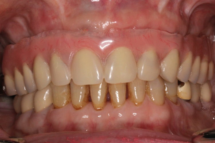 implant retained dentures vancouver bc