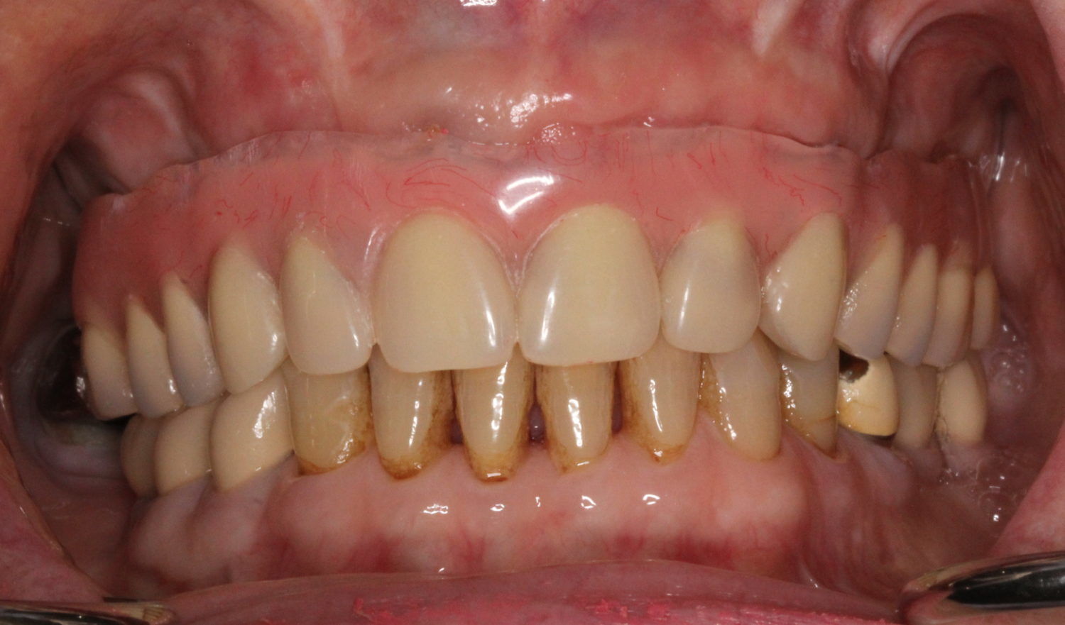 implant retained dentures vancouver bc