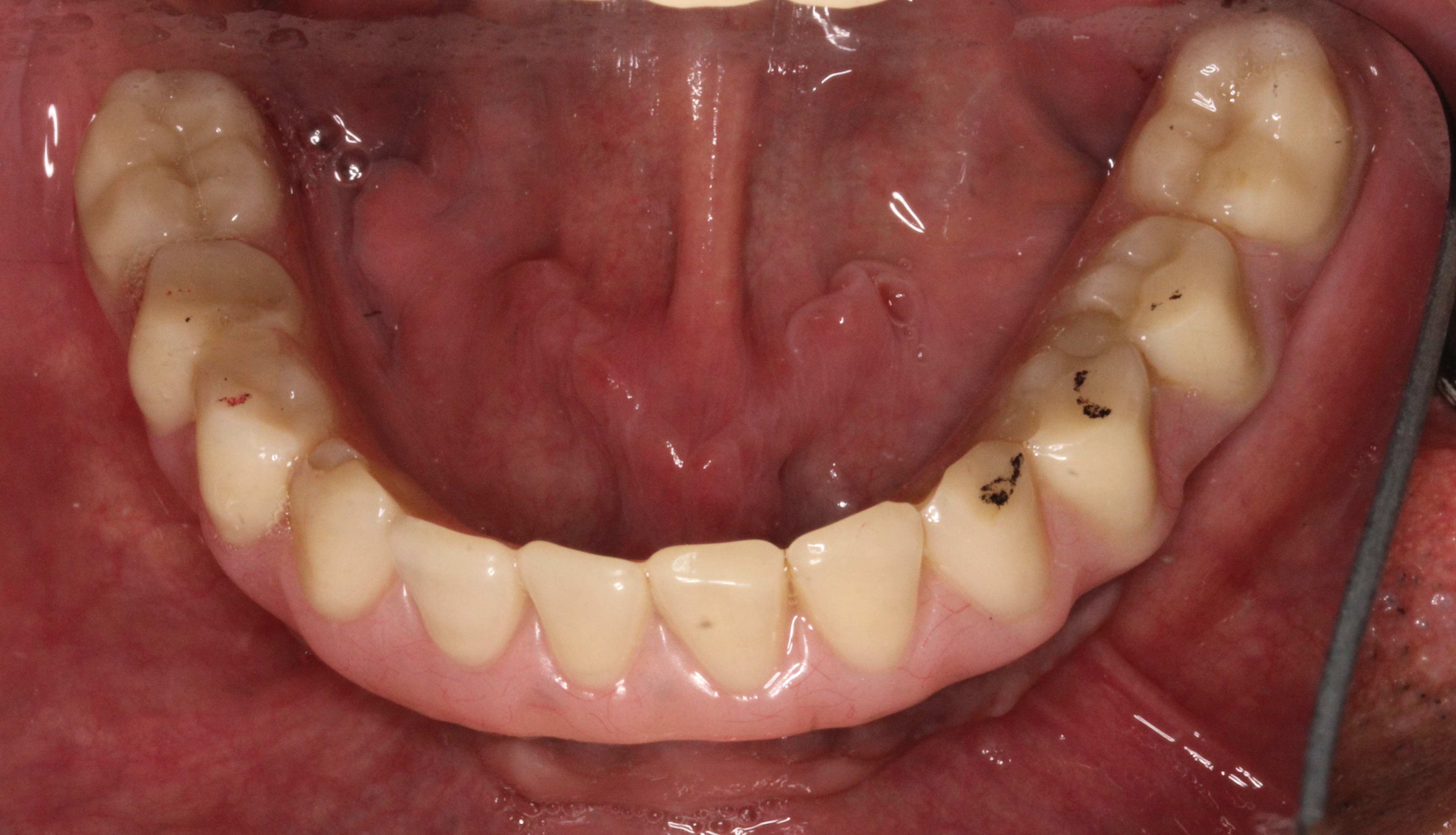 lower implant supported fixed prosthesis