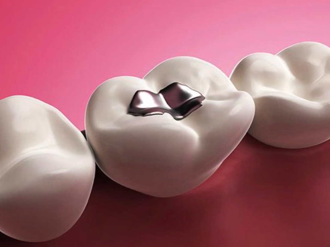 bonded restorations vancouver bc