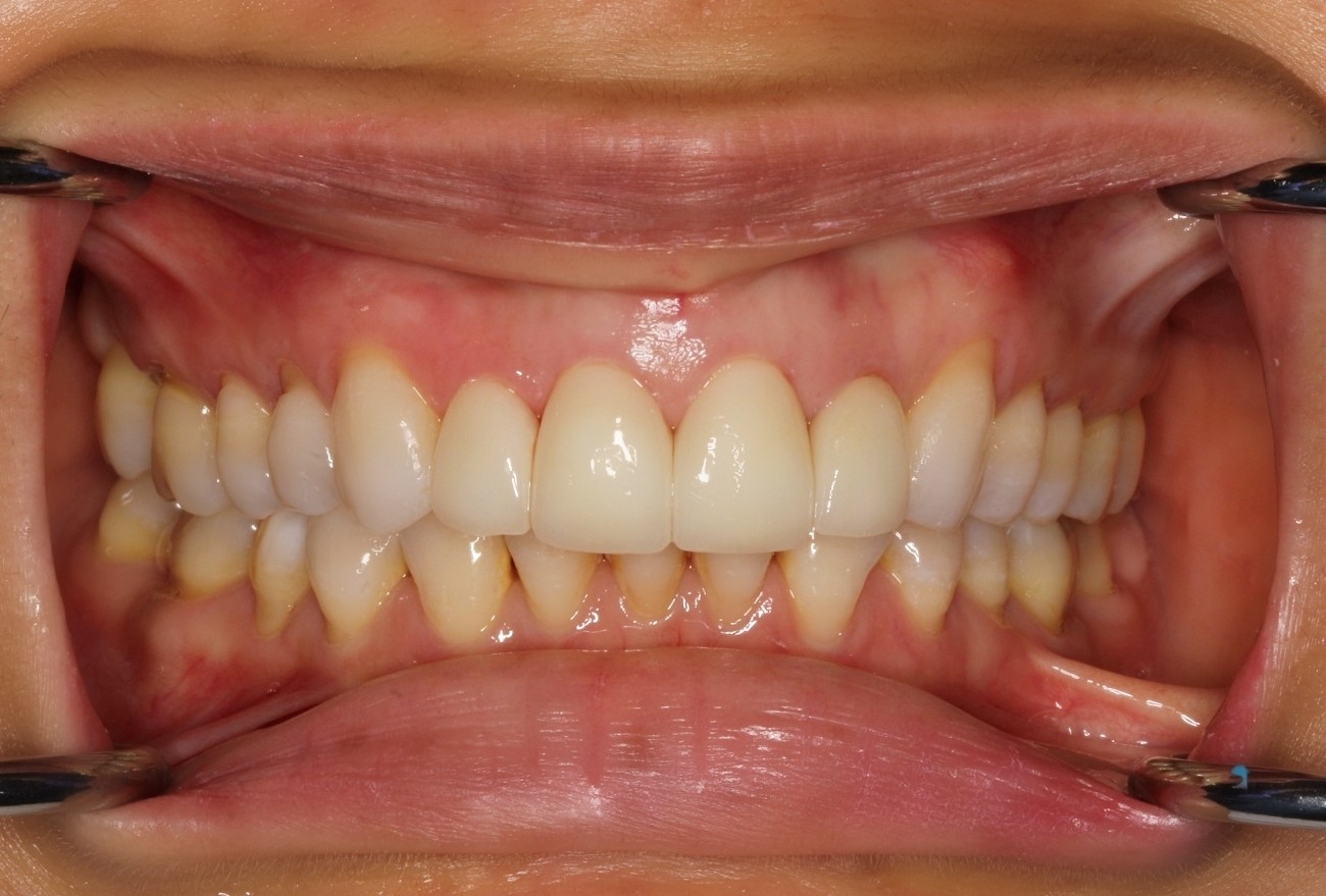 Porcelain Veneers Vancouver BC