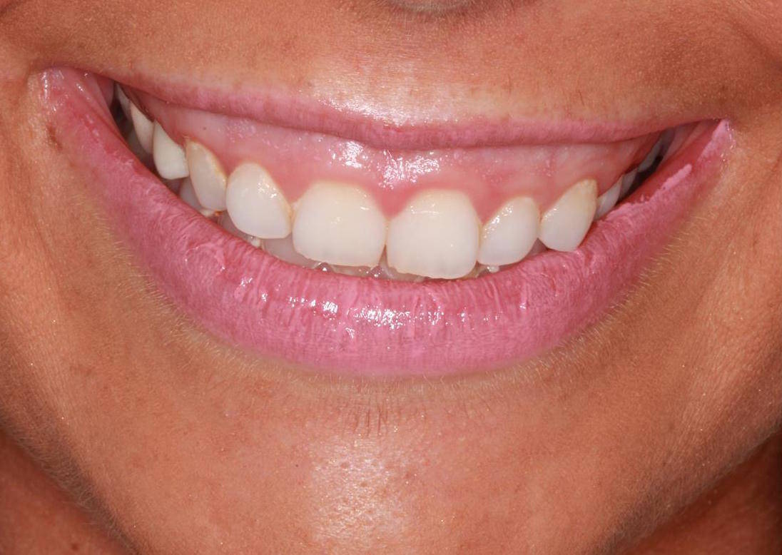 cosmetic periodontal surgery vancouver
