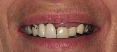 Dental Bridge Vancouver BC