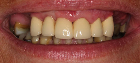 Dental Bridge Vancouver BC