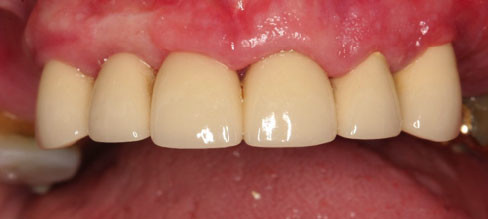Dental Bridge Vancouver BC