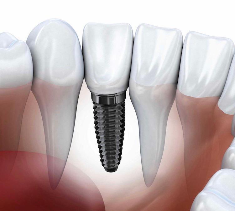 Dental Implant Cost Vancouver BC