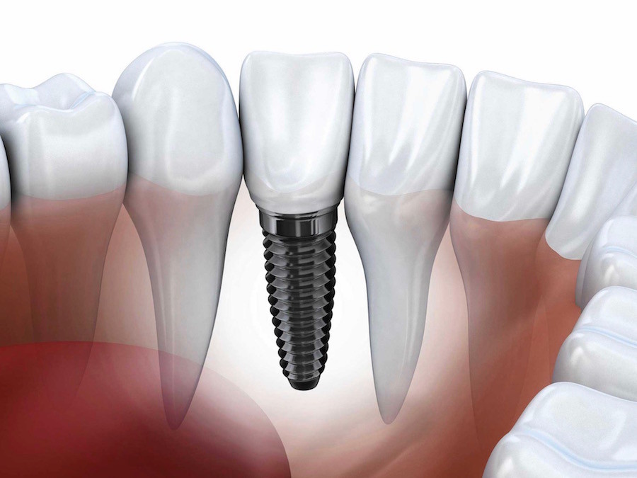 Dental Implant Cost Vancouver BC