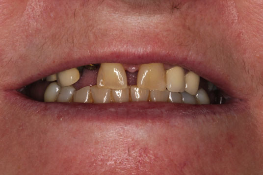 missing teeth vancouver bc