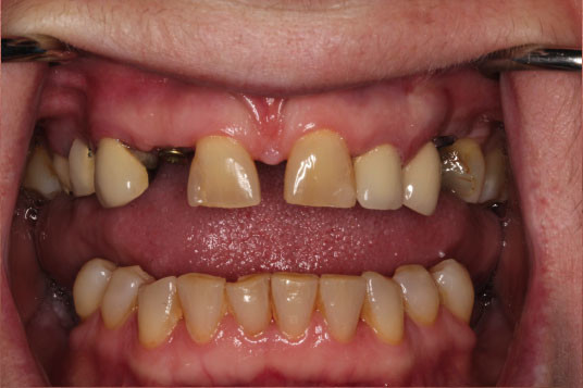 missing teeth vancouver bc