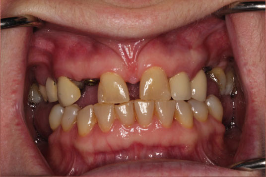 Missing Teeth Vancouver BC