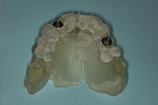 Full Mouth Reconstruction Vancouver BC