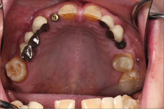Full Mouth Reconstruction Vancouver BC