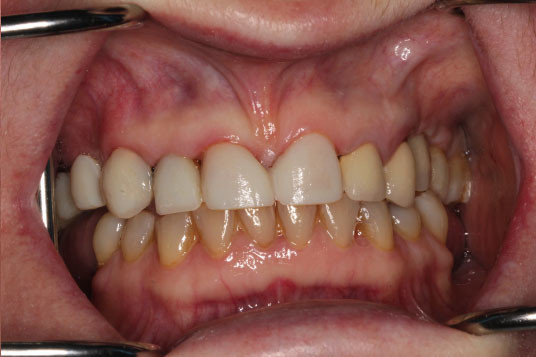 Full Mouth Reconstruction Vancouver BC