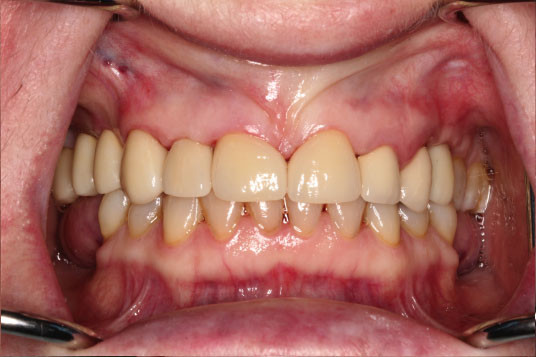 Full Mouth Reconstruction Vancouver BC