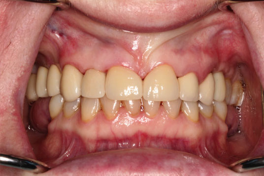 Full Mouth Reconstruction Vancouver BC