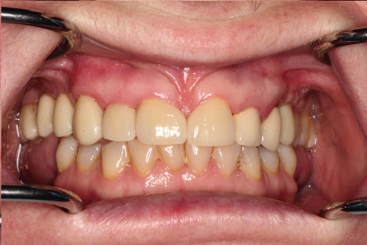 Full Mouth Reconstruction Vancouver BC