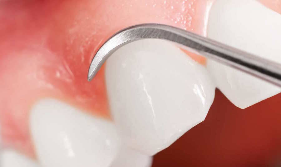 cosmetic periodontal surgery vancouver