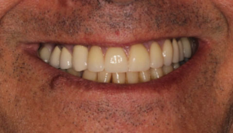 Implant Retained Partial Denture Vancouver BC