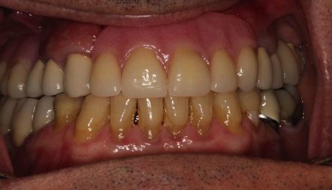 Implant Retained Partial Denture Vancouver BC