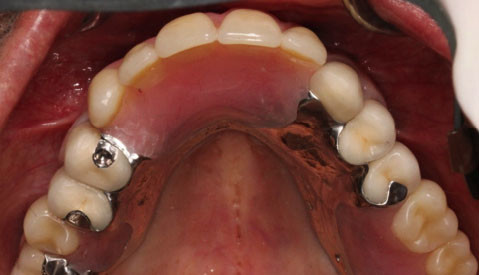 Implant Retained Partial Denture Vancouver BC