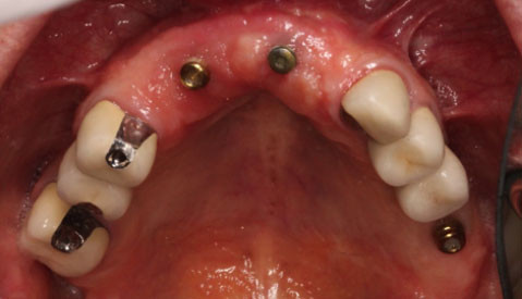 Implant Retained Partial Denture Vancouver BC