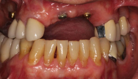 Implant Retained Partial Denture Vancouver BC