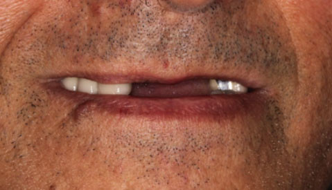 Implant Retained Partial Denture Vancouver BC