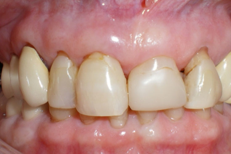 Dental Implants Vancouver BC